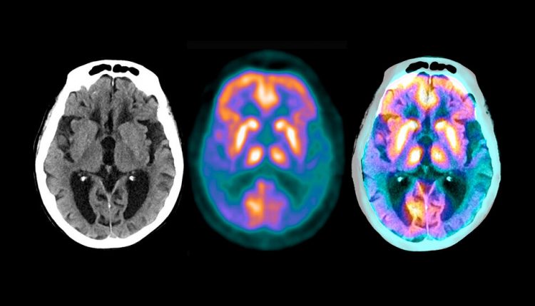 Eli Lilly's Alzheimer's Drug Shows Promise in Small Trial