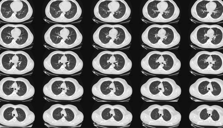 Lung Cancer Scans Are Recommended for People 50 and Older With Shorter Smoking Histories