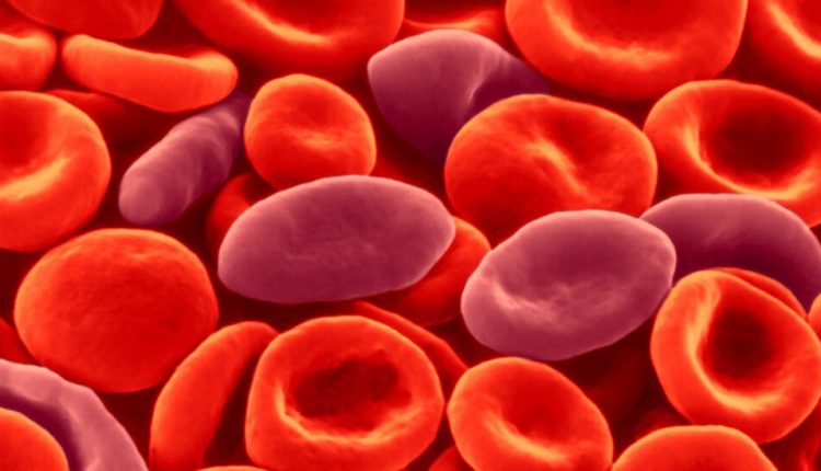 Sickle Cell Treatment Not Linked to Cancer, Researchers Say